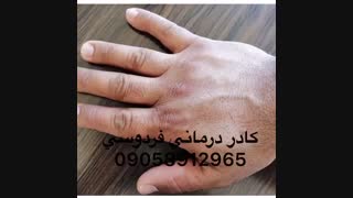 توجه توجه اگزمای پوستی درمان شد!