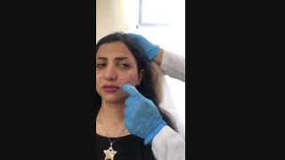 لیفت صورت با تزریق ژل