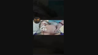 فیلم جالبی از توده ای بزرگ در صورت!!!!!!!!!!