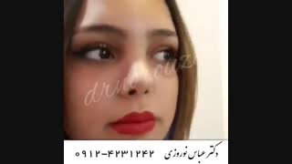نمونه جراحی بینی توسط دکتر عباس نوروزی