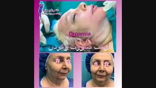 لیفت صورت و گردن توسط دکتر رفیع پرنیا روکش دندان