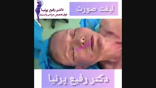 لیفت صورت توسط دکتر رفیع پرنیا ترمیم زیبایی دندان