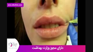 تزریق ژل | فیلم تزریق ژل | کلینیک پوست و مو نیل | شماره 18