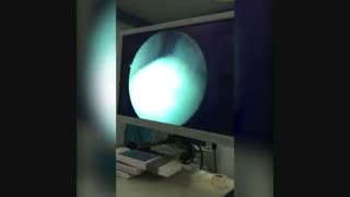 پارگی باکت هندل (دسته سطلی) منیسک