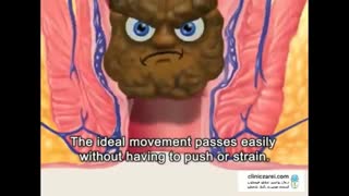 آشنایی با دلایل ایجاد شقاق یا فیشر مقعدی در کلینیک زارعی