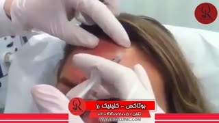 تزریق بوتاکس | فیلم تزریق بوتاکس | کلینیک پوست و مو رز | شماره 24
