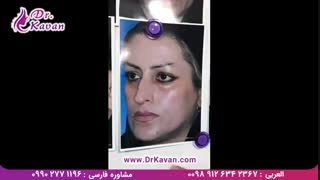 عمل زیبایی بینی توسط دکتر کاوان