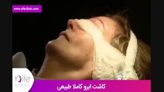 کاشت ابرو | فیلم کاشت ابرو | کلینیک پوست و مو نیل | شماره 19