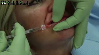 تزریق ژل لب