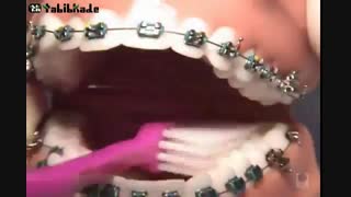 آموزش مسواک زدن دندان های ارتودنسی