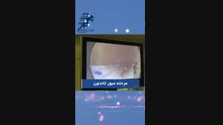 جراحی پارگی رباط صلیبی و منیسک خارجی زانو