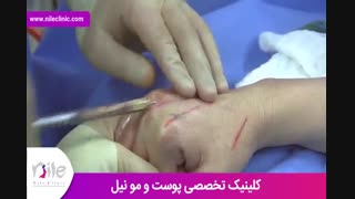 تزریق چربی | فیلم تزریق چربی | کلینیک پوست و مو نیل | شماره 14