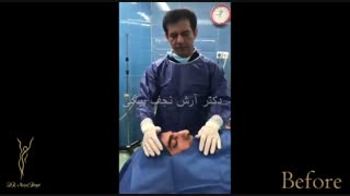 رینوپلاستی