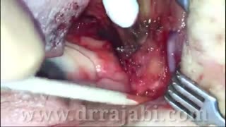 جراحی برداشتن تومور و بازسازی پلک‌ پایین