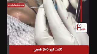 کاشت ابرو | فیلم کاشت ابرو | کلینیک پوست و مو هلیا | شماره 23