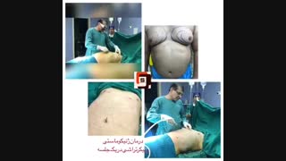 فیلم عمل کوچک کردن سینه یا ژنیکوماستی در مردان