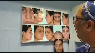 نمونه جراحی زیبایی بینی