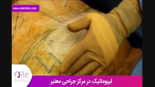 لیپوماتیک | فیلم لیپوماتیک | کلینیک پوست و مو نیل | شماره 19