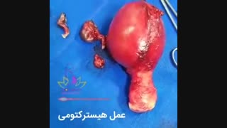 جراحی هیسترکتومی یا عمل برداشتن رحم