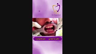 صفر تا صد ونیر کامپوزیت