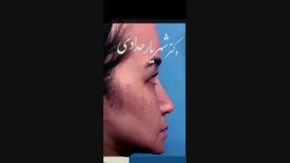 عمل بینی و پلک در بیمار با بینی و پلک مدل آسیایی