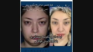 لیفت اندوسکوپی پیشانی و بلفاروپلاستی فوقانی