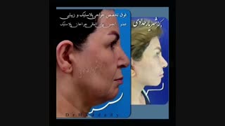 لیفت صورت و گردن