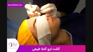کاشت ابرو | فیلم کاشت ابرو | کلینیک پوست و مو نیل | شماره 25