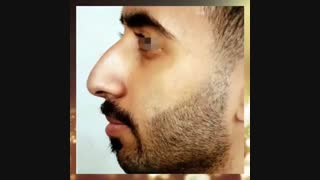 نمونه کار جراحی بینی