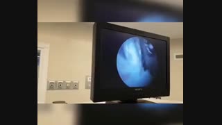 فیلم جراحی آرتروسکوپی پارگی رباط صلیبی زانو