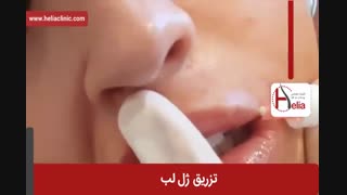 تزریق ژل | فیلم تزریق ژل | کلینیک پوست و مو هلیا | شماره 25