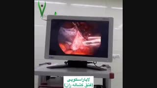 جراحی لاپاراسکوپی فتق کشاله ران توسط دکتر فرجادلرستانی