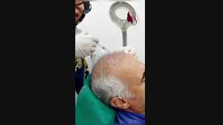 مزوتراپى سه ماه بعد از کاشت مــــو