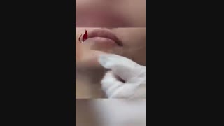 رفع چروک لب و فرمدهی با ژل