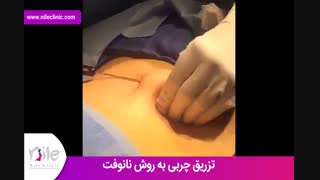 تزریق چربی | فیلم تزریق چربی | کلینیک پوست و مو نیل | شماره 23