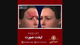 لیفت غبغب