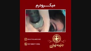 نمونه میکرونیدلینگ