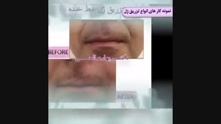 نمونه کار تزریق ژل لب