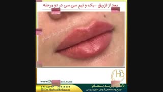 فیلم تزریق ژل لب