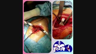 عمل جراحی تعویض مفصل لگن از طریق قدام