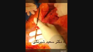 جمع کردن عضلات شکم در جراحی ابدومینوپلاستی