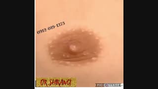 فیلم کوچک کردن سینه در مردان