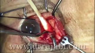 جراحی تومور بزرگ داخل مخروط عضلانی کاسه چشم