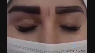 کاشت ابرو با بهترین تراکم
