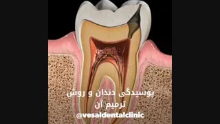 پوسیدگی دندان و ترمیم آن