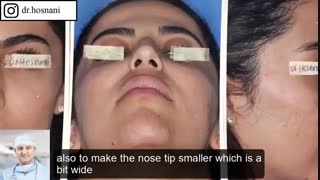 ورم سوراخ های بینی ظرف چند هفته بعد از عمل میخوابد