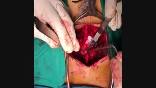 نمونه عمل جراحی فقرات کمری (دکتر محسن القاسی)