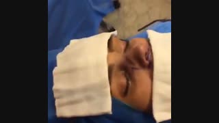 عمل جراحی بینی استخوانی