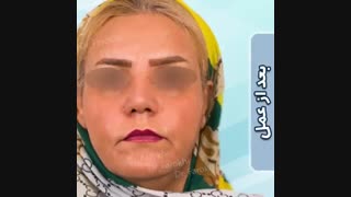فیلم قبل و بعد جراحی زیبایی بینی
