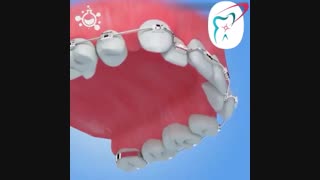 ارتودنسی ثابت جهت منظم کردن دندان ها